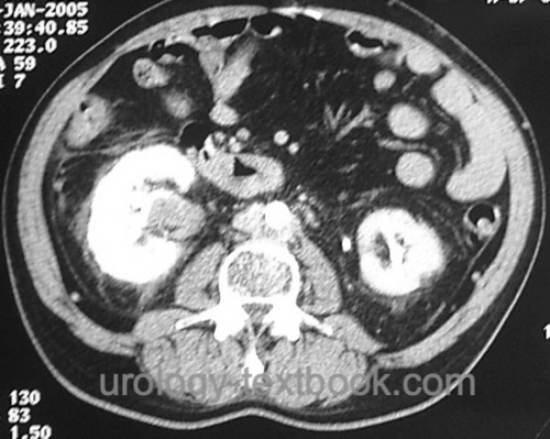 figure Abdominal contrast-enhancing CT with a filling defect in the renal pelvis as a sign of UTUC.