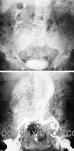 fig. angiography of unilaterally fused kidneys with inferior ectopia