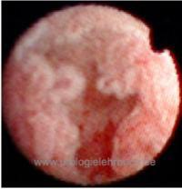 figure flexible ureteroscopy: papillary upper tract urothelial carcinoma of a renal calyx.