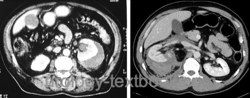 figure CT imaging in renal trauma