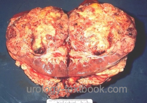 figure surgical specimen of renal cell carcinoma