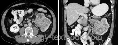 figure Abdominal CT of a pT3a renal cell carcinoma