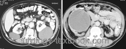 fig. CT of simple renal cysts