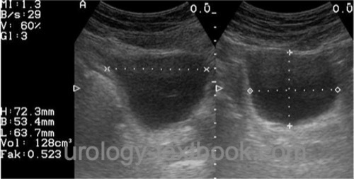 figure ultrasound measurement of postvoid residual urine volume