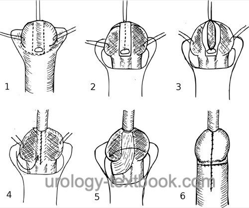 figure Tubularized incised plate urethroplasty