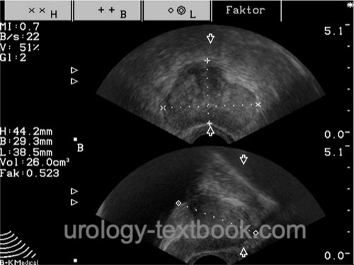 figure Transrectal ultrasonography of the prostate: measuring prostate volume
