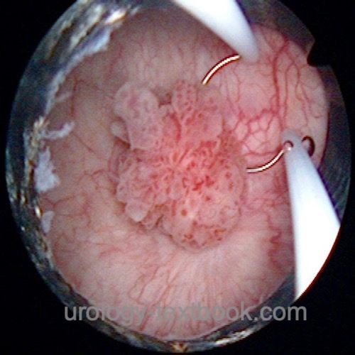 figure TURB transurethral resection of the bladder due to bladder cancer