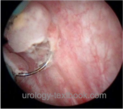 fig2: TURB resection loop