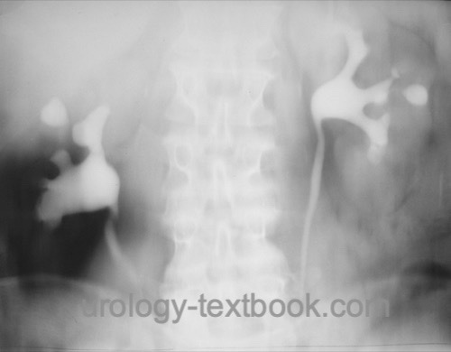 figure tomography of renal manifestation of urogenital tuberculosis