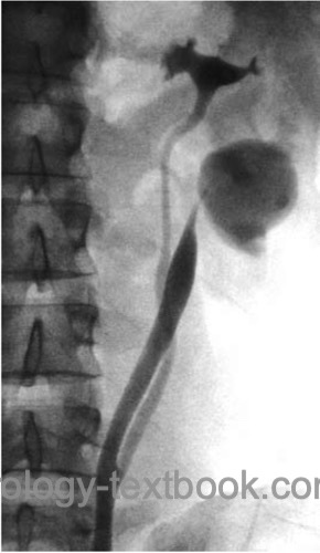 figure ureteropelvic junction obstruction of a duplex system of the kidney