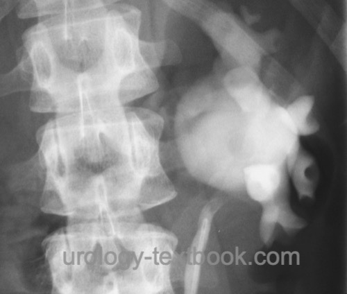 figure UPJ obstruction of the left kidney in 
Retrograde pyelography