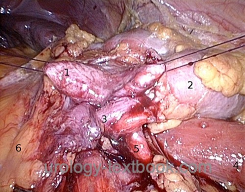 figure intraoperative findings of a UPJ obstruction caused by a lower pole renal vessel