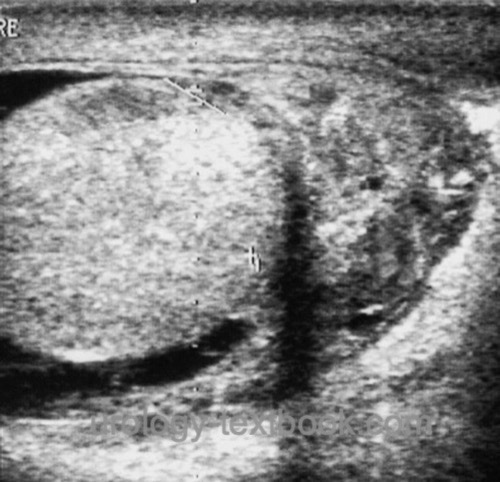 ultrasound imaging of an epididymitis