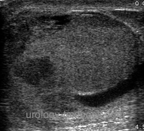 figure Ultrasound imaging of a three-day-old testicular rupture