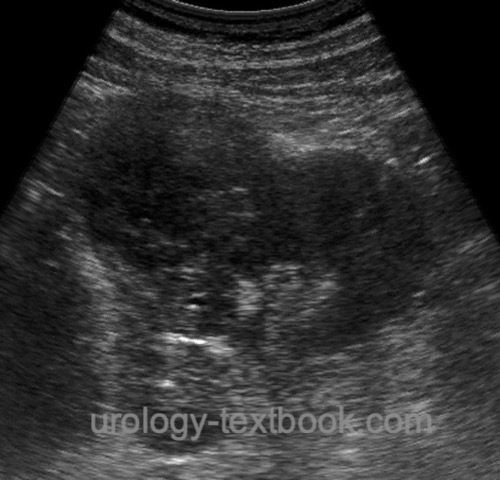 figure ultrasound imaging of a large renal cell carcinoma
