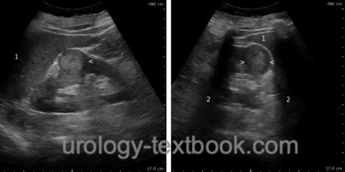 figure ultrasound imaging of a large renal cell carcinoma