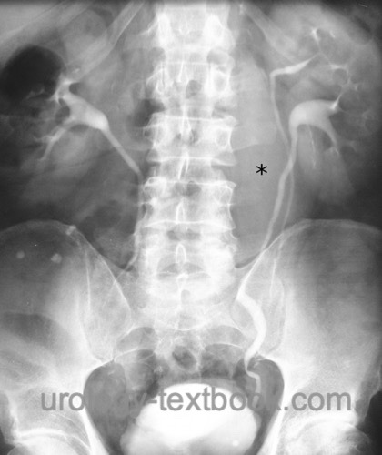 Ureter urogram in the double system of kidney ureter
