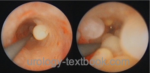 fig. ureteroscopy: findings in ureteritis cystica