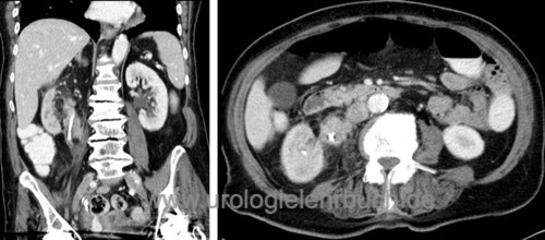 figure Abdominal contrast-enhancing CT: proximal ureteral carcinoma with indwelling ureteral stent
