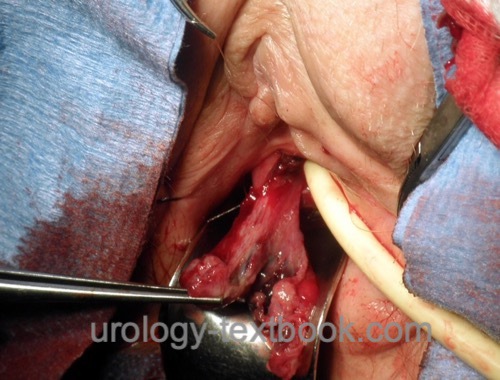 A review of the diagnosis and management of urethral caruncles