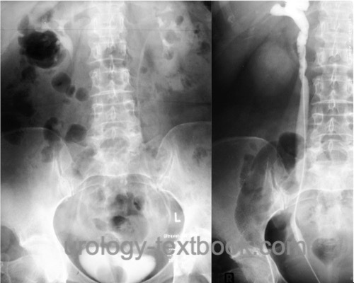 figure ureterocele causes filling defect in urography