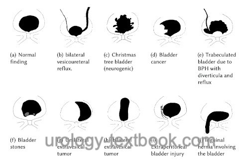 figure Differential diagnosis of findings in cystography