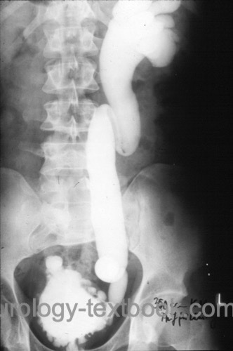 figure Vesicoureteral reflux (Grade V) in VCUG: in addition, a small bladder capacity with multiple pseudodiverticles is depicted as a sign of a neurogenic bladder disorder