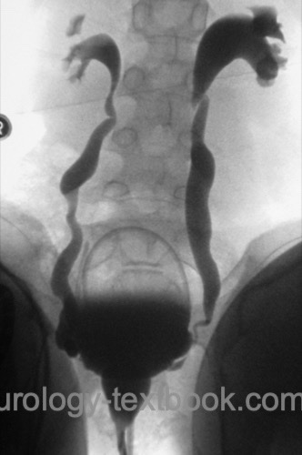 figure Urodynamics and VCUG in a girl with vesicoureteral reflux: third to fourth degree reflux due to detrusor-sphincter dyscoordination