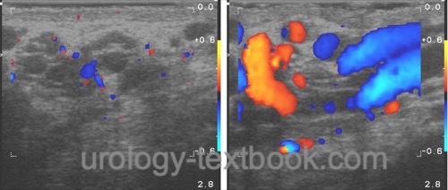 figure Ultrasound imaging of the spermatic cord with varicocele testis