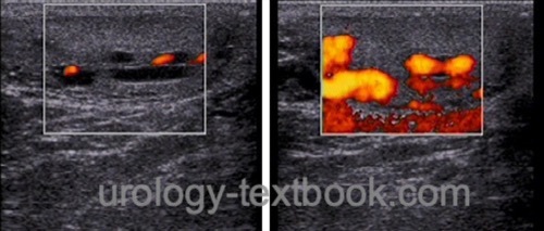 figure Testicular ultrasound imaging of a left-sided intratesticular varicocele with testicular atrophy