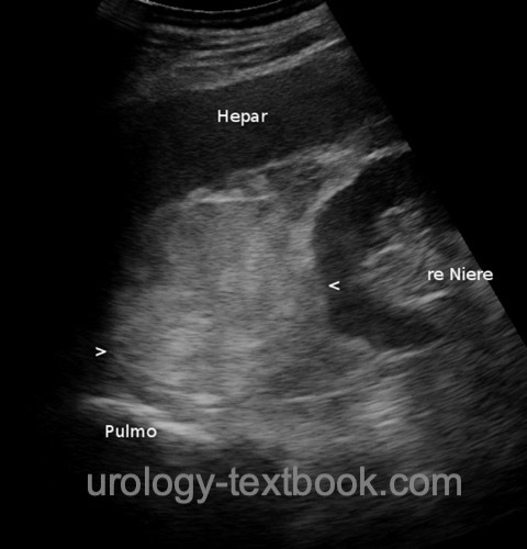figure Ultrasound imaging of the right retroperitoneum showing an 8 cm adrenal tumor.