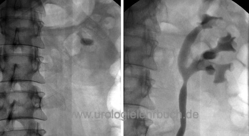 figure nephrolithiasis in plain x-ray and with retrograde pyelography