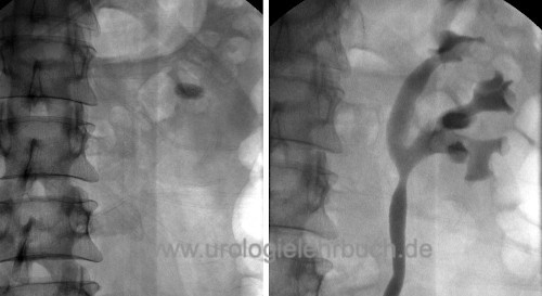 nephrolithiasis x ray