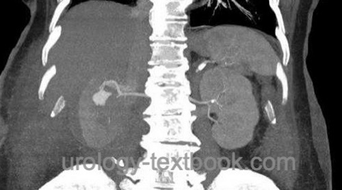 figure CT scan of false aneurysm after partial nephrectomy
