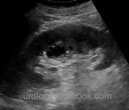 figure: renal ultrasound imaging of a small renal abscess