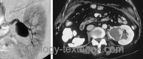 figure Angiography and CT of a true leftsided renal artery aneurysm.