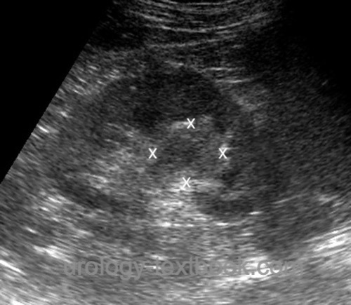figure Ultrasound imaging of upper tract urothelial carcinoma.