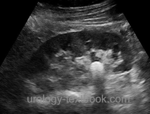 figure Ultrasound imaging of a renal pelvic calculus