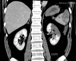 fig. computed tomography of a left-sided partial renal infarction