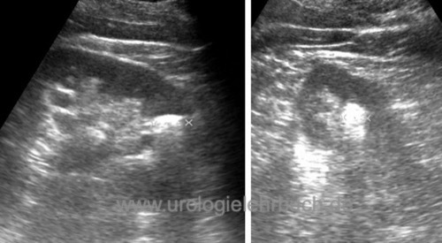 figure Ultrasound imaging of a lower pole calyceal stone with echogenic reflex and dorsal acoustic shadow