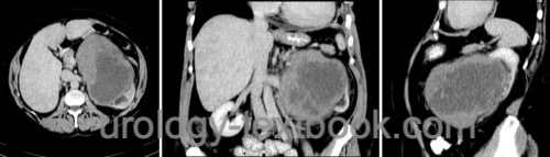 CT scans of a large renal sarcoma