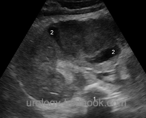 figure renal ultrasound imaging of large renal abscess