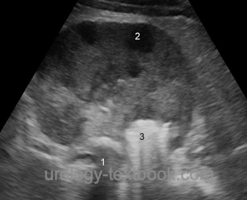 figure renal ultrasound imaging of large renal abscess