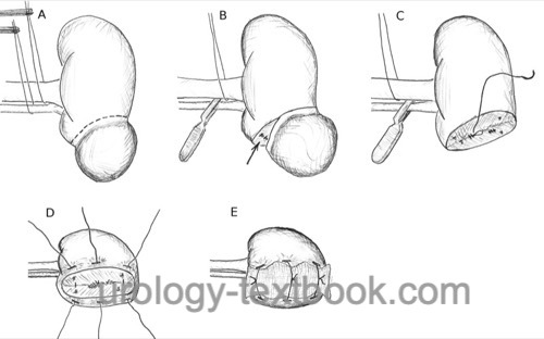 figure open partial nephrectomy surgical technique
