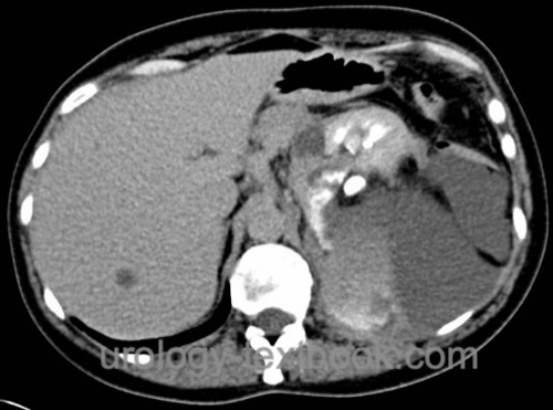  figure CT of urinoma after partial nephrectomy