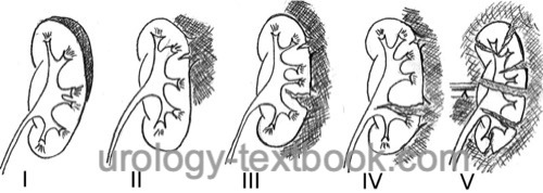 figure AAST classification of renal trauma