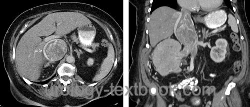 figure Abdominal CT: large tumor thrombus of a right-sided renal cell carcinoma