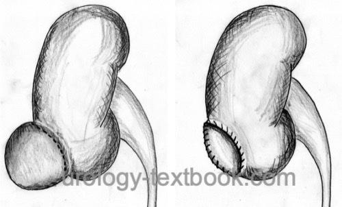 Marsupialization (deroofing) of a renal cyst
