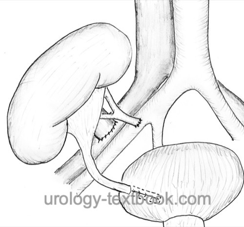 Figure schematic drawing of right-sided kidney transplantation with vascular anastomosis to the iliac vessels