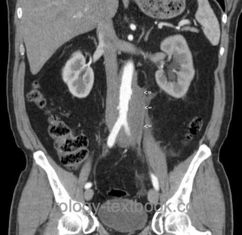 figure ct scan in retroperitoneal fibrosis: circular mass around the aorta